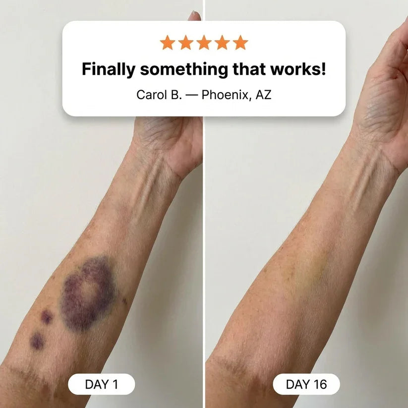💥300K+ SOLD💕-TopSpire® Bruise Repair & Skin-Strengthening Cream
